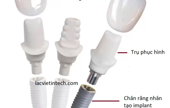 Trồng răng Implant có chụp MRI được không? Khi nào không thể chụp?