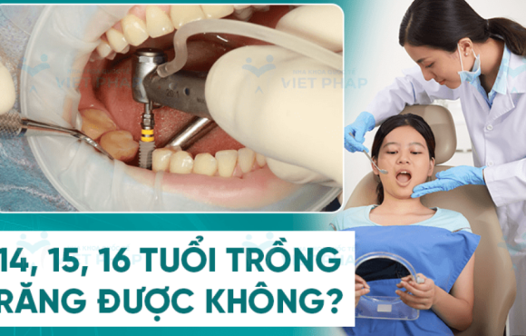 14,15,16 tuổi trồng răng được không? 5 rủi ro bạn cần biết